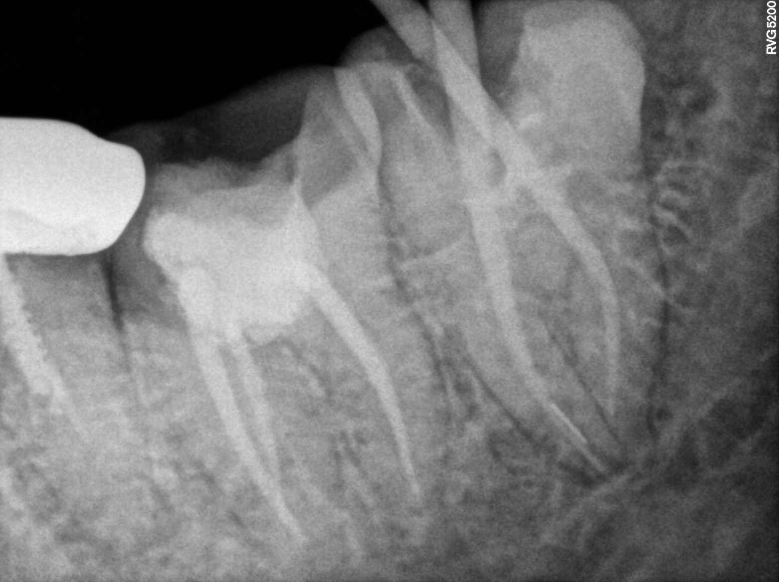 Dental X-ray